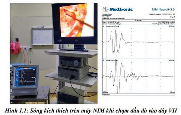 Nghiên cứu áp dụng kỹ thuật sinh học phân tử và chẩn đoán hình ảnh để nâng cao chất lượng chẩn đoán, điều trị điếc bẩm sinh ở trẻ em bằng cấy ốc tai điện tử