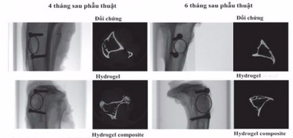 Sử dụng vật liệu y sinh để tái tạo xương
