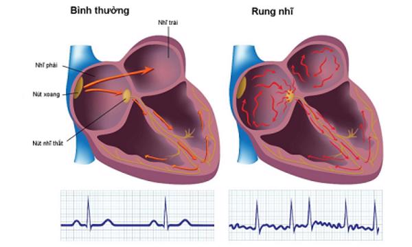 Dùng AI xác định cơn rung nhĩ từ máy đo tín hiệu điện tim cầm tay