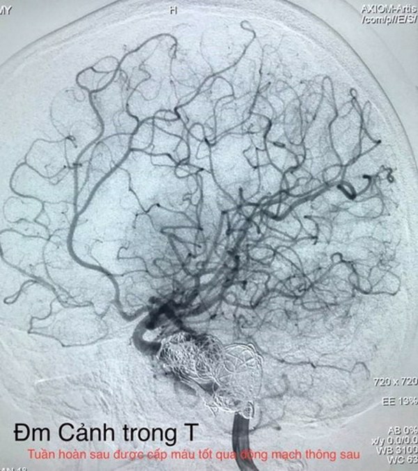 Lần đầu can thiệp mạch máu não không gây mê cứu sống bé gái 15 tuổi
