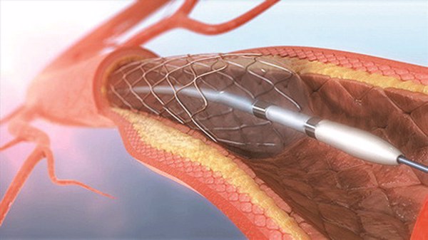 Nghiên cứu tính an toàn của stent mạch vành sản xuất tại Việt Nam