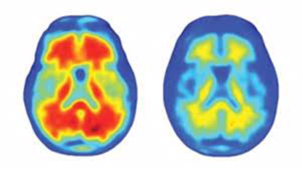 FDA phê duyệt thuốc điều trị Alzheimer mới