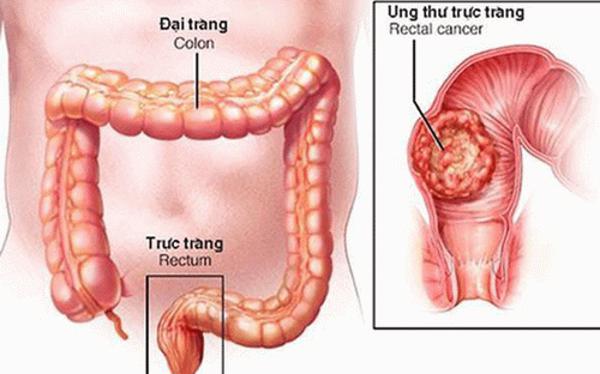 Nghiên cứu phát hiện sớm ung thư đại trực tràng