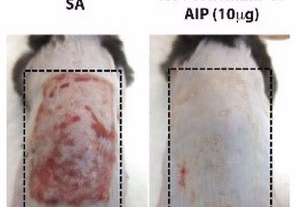 Nghiên cứu cho thấy sự mất cân bằng microbiome trên da có khả năng bùng phát bệnh chàm