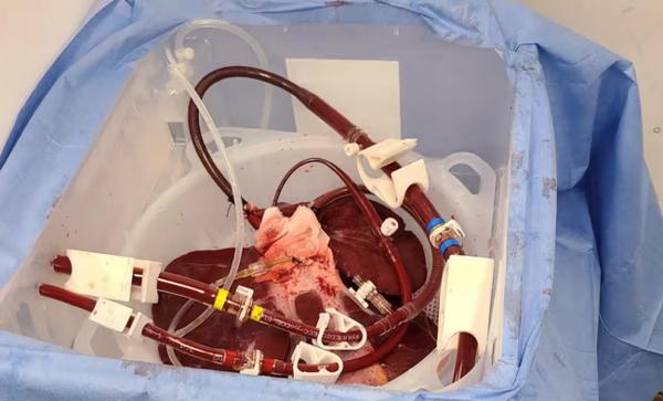 Thử nghiệm dùng gan lợn để lọc máu từ bên ngoài cơ thể
