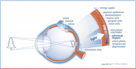 Mô tả hoạt động của chip sinh học hỗ trợ thị lực.