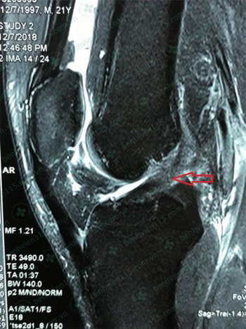 Hình ảnh MRI khớp gối phải cho thấy dây chằng chéo trước đứt hoàn toàn